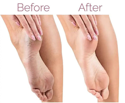 Electric Rechargeable Callus Remover™